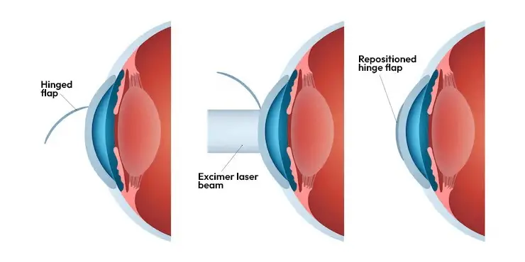 लेसिक सर्जरी क्या है